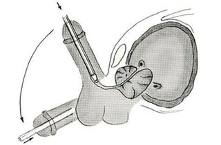 Schéma de chirurgie endoscopique d'agrandissement du pénis